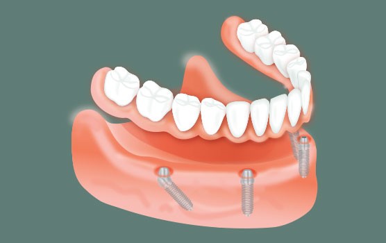 Implant Retained Dentures Colmar PA 18915